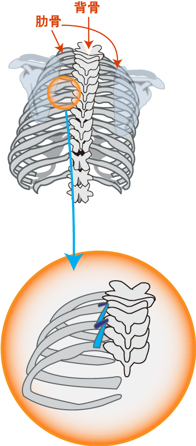 左肋間痛のイメージ図